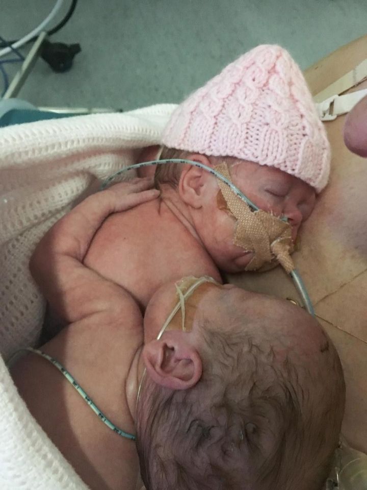 Новорождённая кроха обняла сестру-близняшку, которая вот-вот перестанет дышать