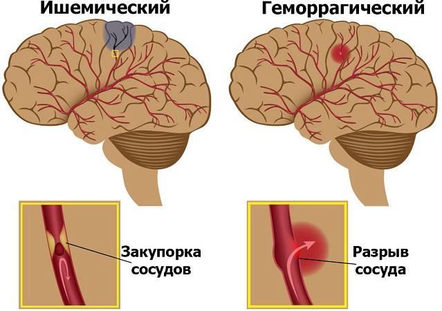 В связи с днем борьбы с инсультом 29 октября, мамадышцам рассказали об основных факторах риска, признаках болезни и первой помощи
